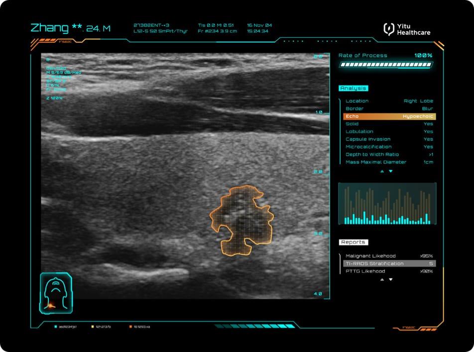 care.aiTM 甲狀腺超聲智能診斷系統(tǒng)